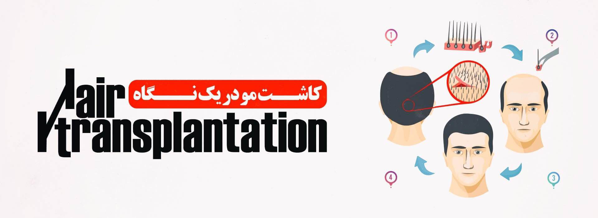 کاشت مو آنیکا